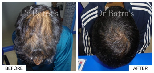 Hair Falling Treatment